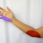 Sindromul de tunel cubital la nivelul cotului