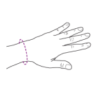 Cum stim care este tratamentul corect in sindromul de tunel carpian?
