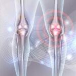 Ce este condromalacia patelara
