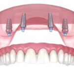 Ce inseamna la GermanDent un implant dentar ieftin?