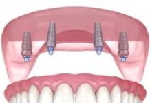 Ce inseamna la GermanDent un implant dentar ieftin?